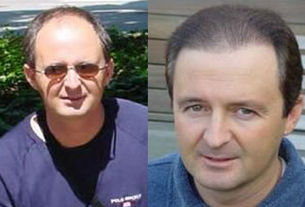 Before And After FUE Strip Procedure, 2100 plus 1800 graft FUE