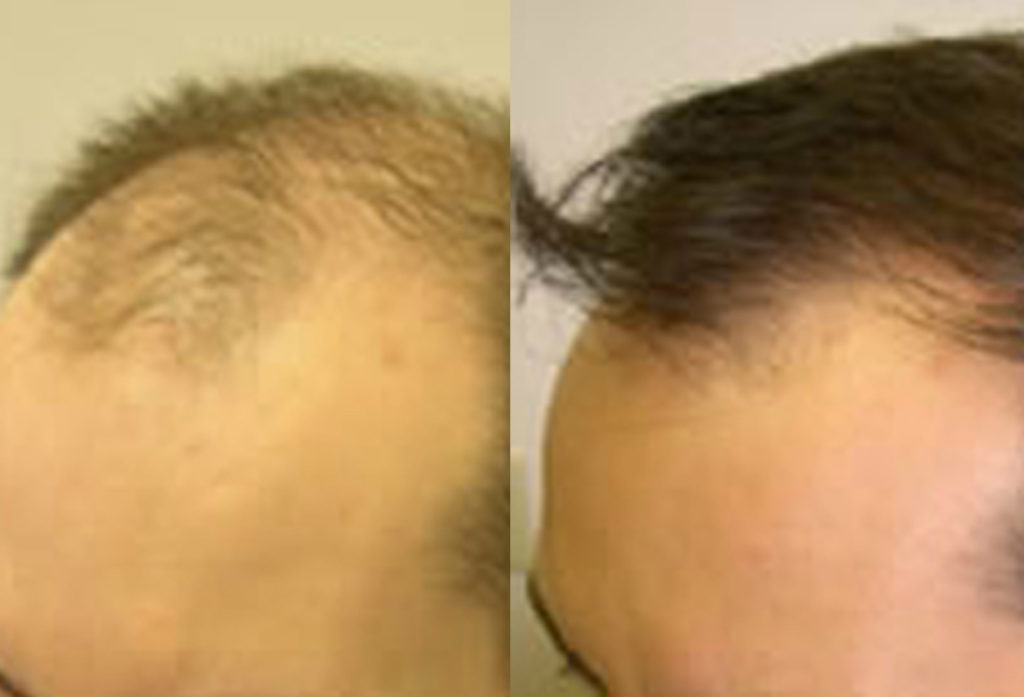 Before And After FUE Procedure, 2500 grafts - Toronto Hair Transplant ...