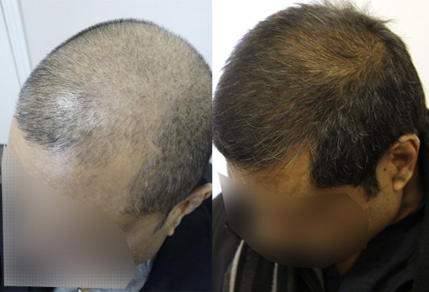 Before And After FUE Procedure, 40 Year Old Male, 3000 Graft