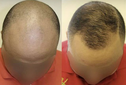 Before And After FUE Procedure, 3000 Grafts