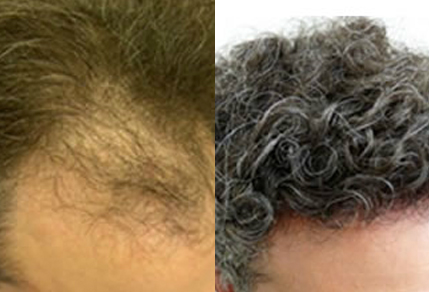 Before And After Graft Transplant, 39 year old male, 3000 grafts