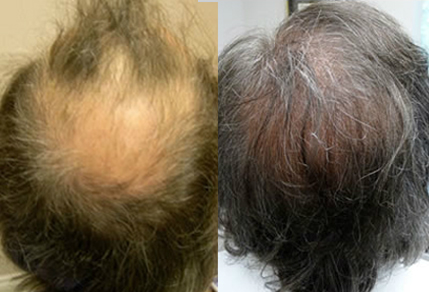 Before And After, 56 year old male, 3000 grafts