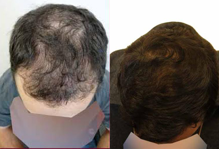 Before And After Graft Strip Procedure, 32 Year Old Male, 3500 Grafts