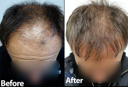 Before and After Graft Strip Surgery, 3500 Grafts