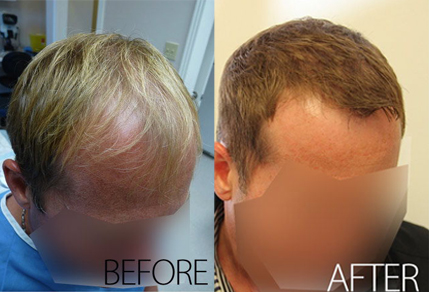 Before And After Graft Strip Surgery, 39 Year Old Male, 3630 Grafts