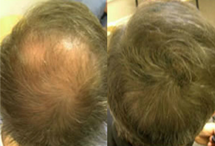 Before And After, 53 year old male, 4000 grafts