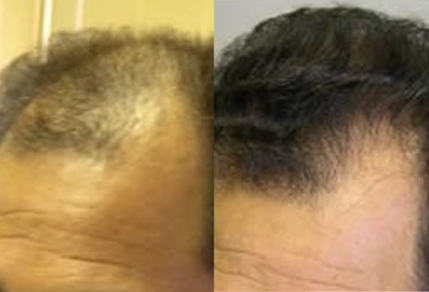 Before And After graft strip Procedure, 45 year old male, 2500 grafts