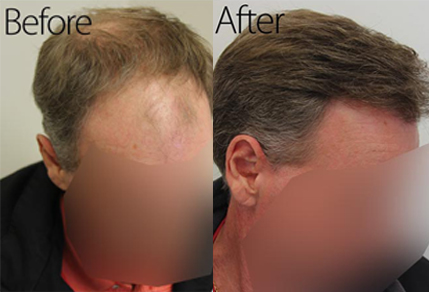 Before And After Graft Strip Surgery, 50 Year Old Male, 3078 Graft Strip