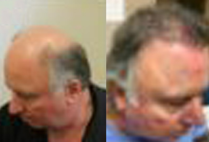 Before and After Graft Strip Procedure, 60 Year Old Man, 3000 Grafts