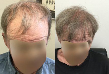 Before And After graft strip procedure, 70 year old Male, 3000 grafts