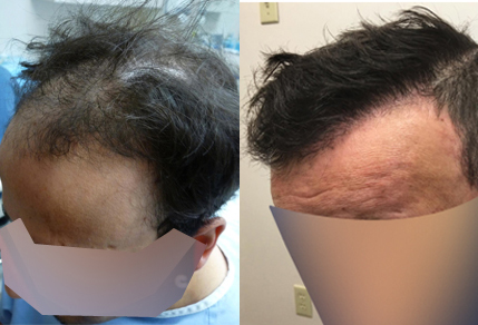 Before And After Graft strip Procedure, 38 year old male, 3800 Graft