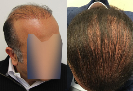 Before and after Plug repair procedure, 50 year old male, 5000 grafts