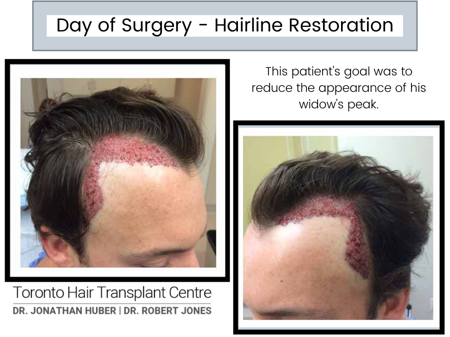 Day Of Surgery – Hairline Restoration, 2500 grafts