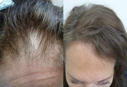 Before And After Hair Restoration, 50 years old Female, 1500 grafts