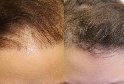 Before And After Hair Transplant procedure, 52 year old Female, 2036 grafts