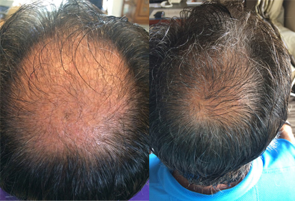 Before And After Grafts Strip Surgery, 50year old male, 3000 grafts