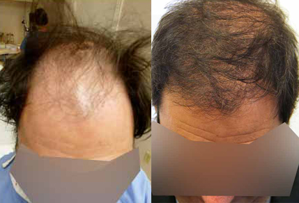 Before And After Strip Procedure, 52 Year Old Male, 3500 Grafts