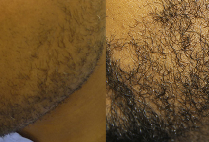 Before And After Beard Transplant Procedure