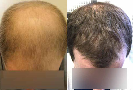 Before And After FUE Procedure, 33 Year Old Male, 3500 Grafts