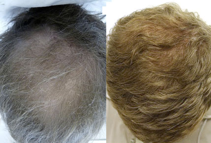 Before And After Graft Hair Transplant, 40 Year Old Male, 5200 Grafts