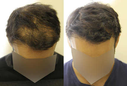 Before And After Graft Hair Transplant Procedure, 35 Year Old Male, 3500 Grafts