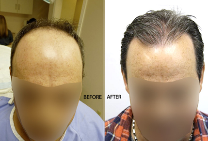 Before And After Graft Strip Surgery, 47 Year Old Male, 3500 Grafts