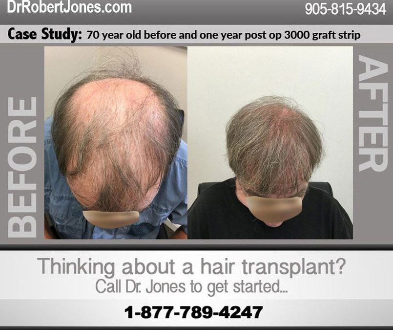 70 year old before and one year post op 3000 graft strip