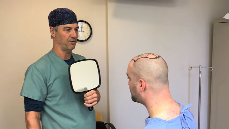 In depth look at a recent 3000-graft FUE hair transplant