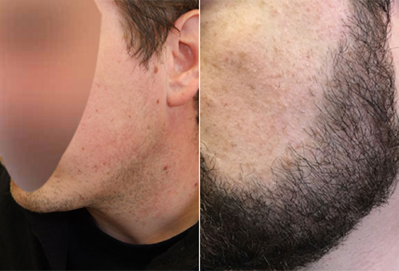 Before And After Beard Transplant Procedure