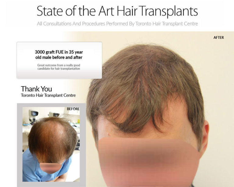 3000 Graft FUE Hair Transplant Toronto Hair Transplant Centre