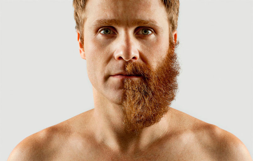 Beard Transplants Destroying Razor Industry