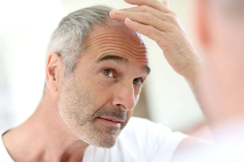 Is Propecia or Rogaine an Alternative To Hair Transplantation?