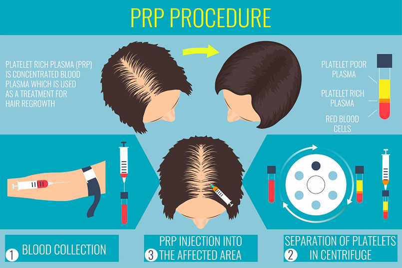 Platelet-Rich Plasma May Be The Answer