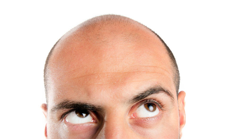 10 Signs You’re Ready for a Hair Transplant