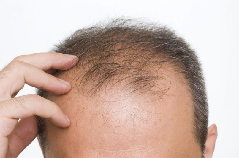 1,500-Graft Cases – 1,500-Unit Hair Transplants