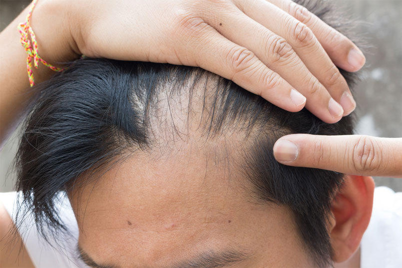 Why Me? Androgenetic Alopecia
