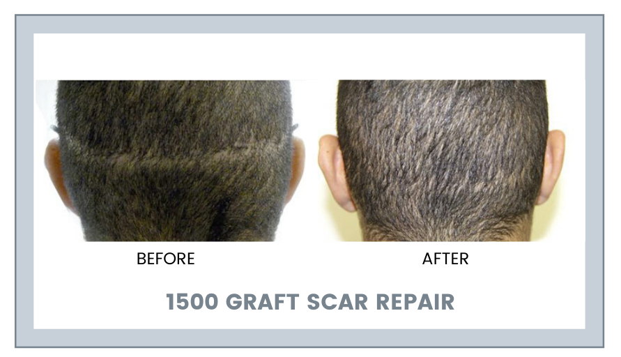 What are the Options for Scar reduction?