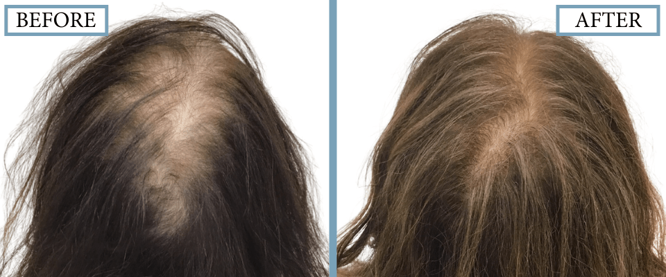 PRP, Minoxidil and Low-Level Laser Therapy