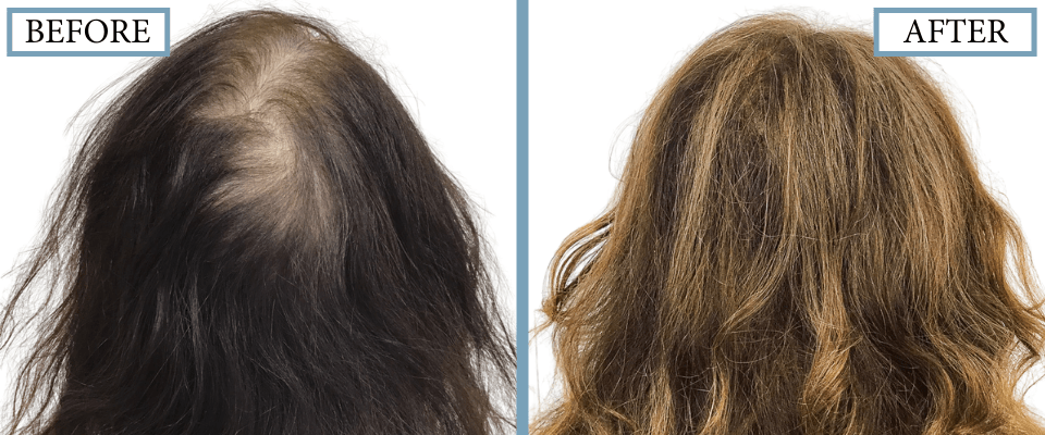 PRP, Minoxidil and Low-Level Laser Therapy