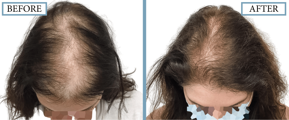 PRP, Minoxidil and Low-Level Laser Therapy