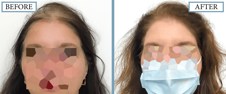 PRP, Minoxidil and Low-Level Laser Therapy