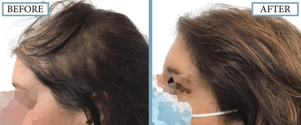 PRP, Minoxidil and Low-Level Laser Therapy