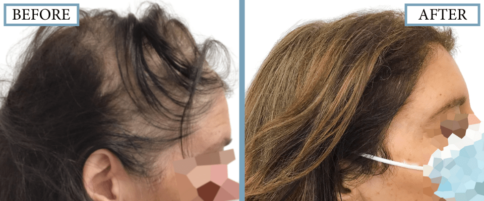 PRP, Minoxidil and Low-Level Laser Therapy
