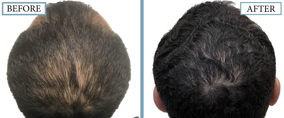 THTS Before and After FUE