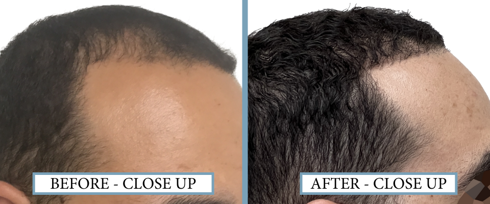 THTS Before and After FUE