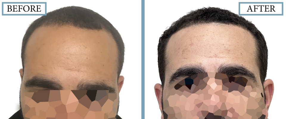 THTS Before and After FUE