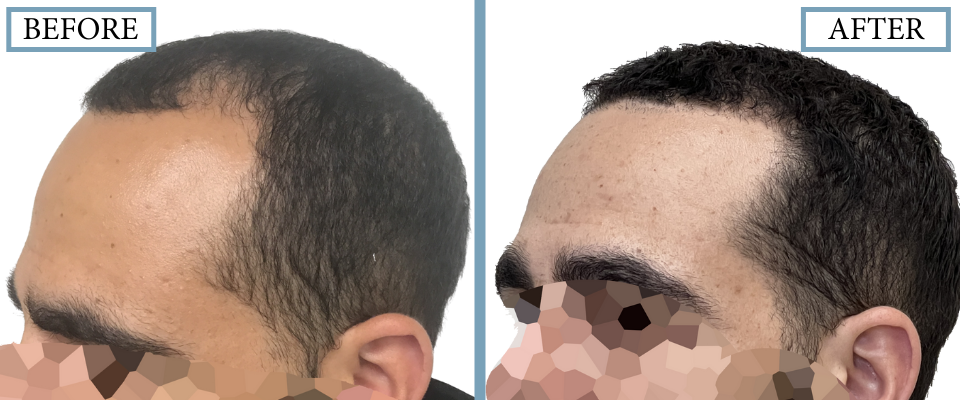 THTS Before and After FUE