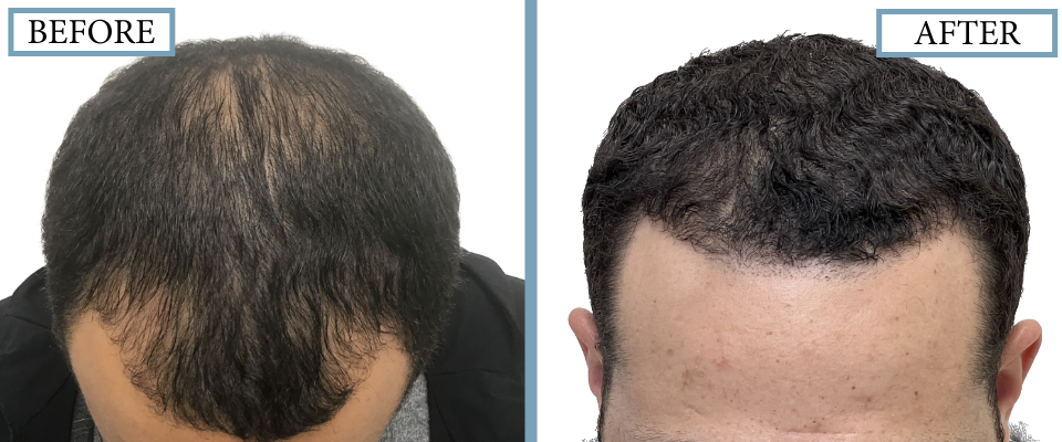 THTS Before and After FUE