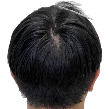 THTS Before and After FUE