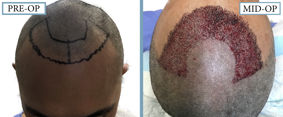 THTS Before and After FUE